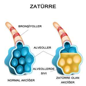 zaturre-2